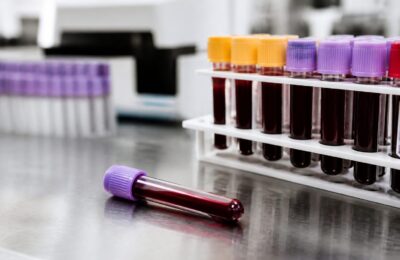 Un nou test de sânge poate detecta mai fin urmele de cancer pancreatic la pacienții monitorizați