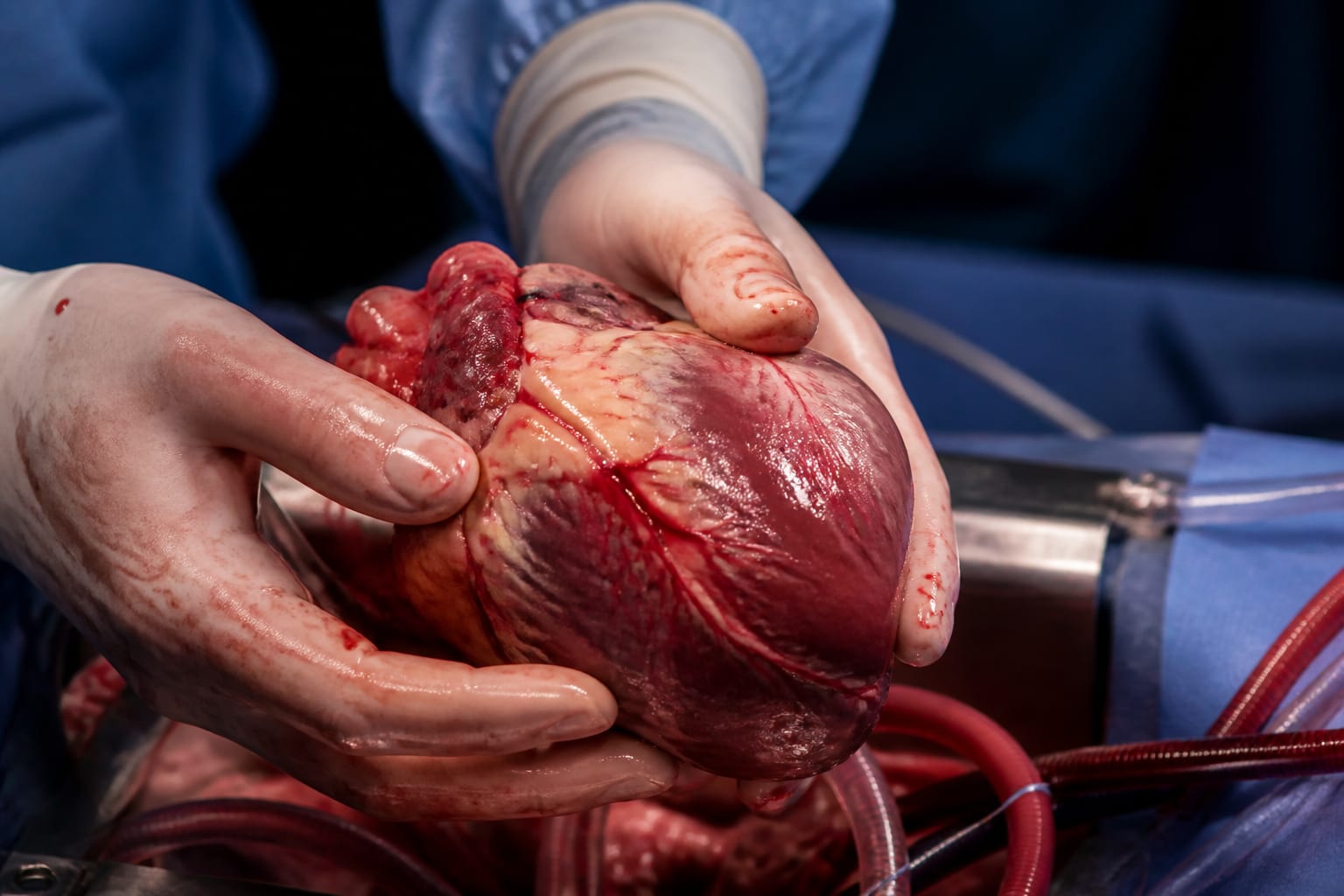 Primul transplant de inimă de la Institutul de Boli Cardiovasculare din Iași a salvat un pacient de 44 de ani