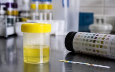 Proteinuria sub 1 g pe zi poate reveni la normal după renunțarea la alcool