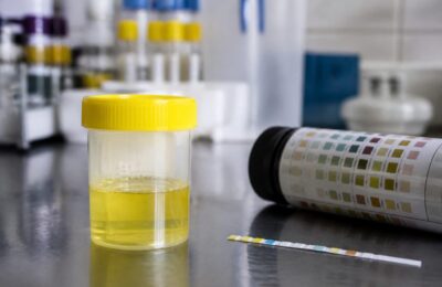 Proteinuria sub 1 g pe zi poate reveni la normal după renunțarea la alcool