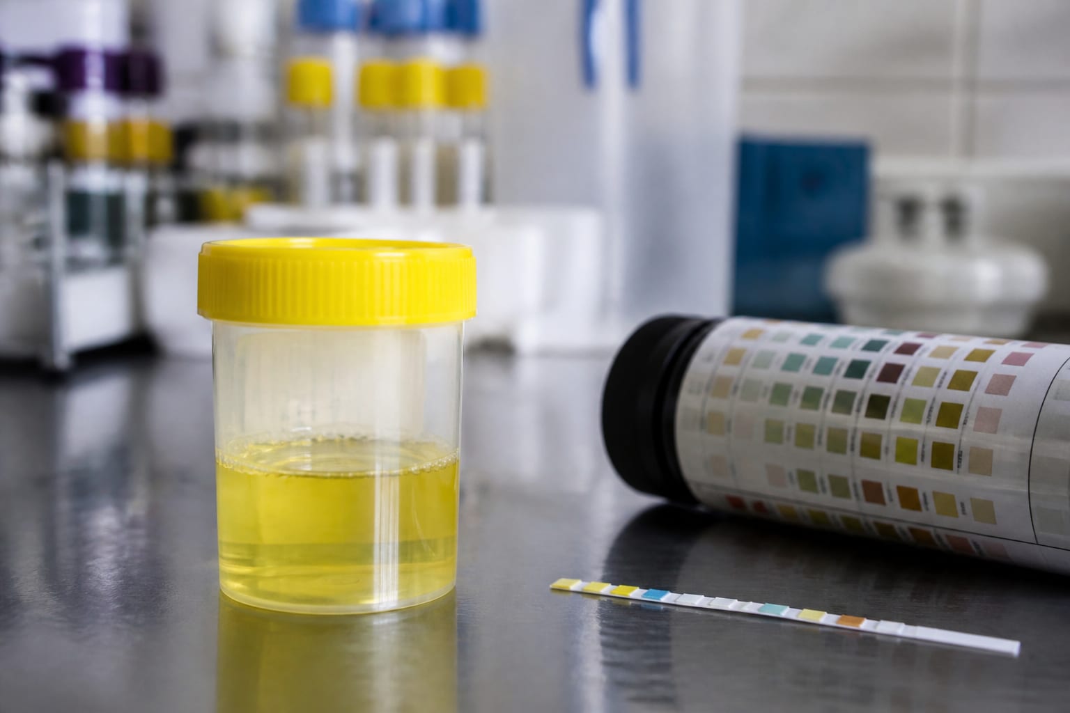 Proteinuria sub 1 g pe zi poate reveni la normal după renunțarea la alcool
