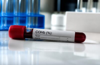 Un marker din sânge a prezis mai bine riscul de Alzheimer înainte de simptome
