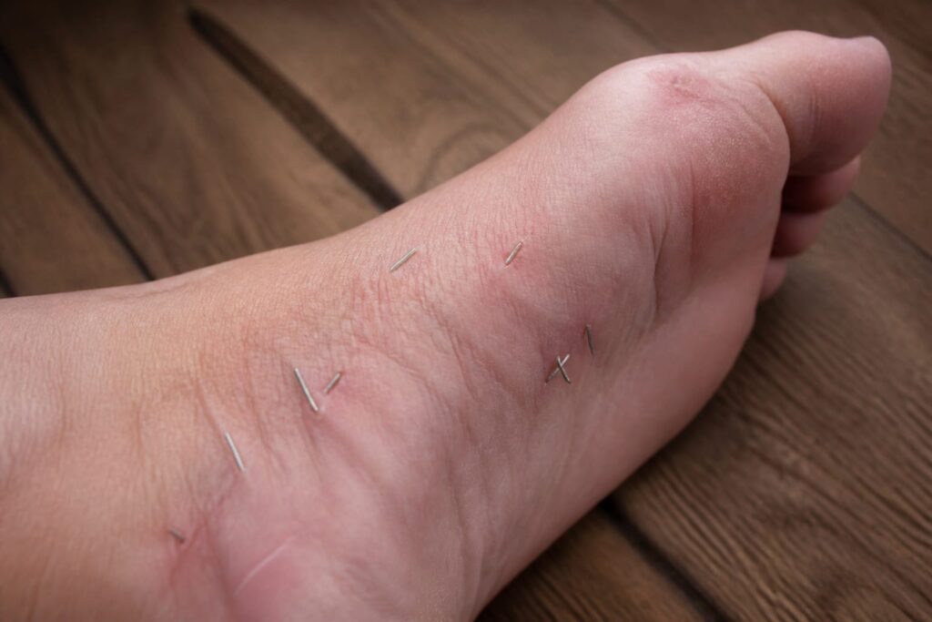 O femeie a ajuns la spital cu peste 10 fragmente de ace în picior după o ședință de acupunctură