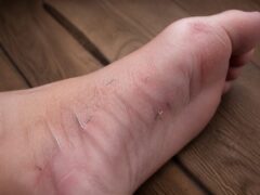O femeie a ajuns la spital cu peste 10 fragmente de ace în picior după o ședință de acupunctură