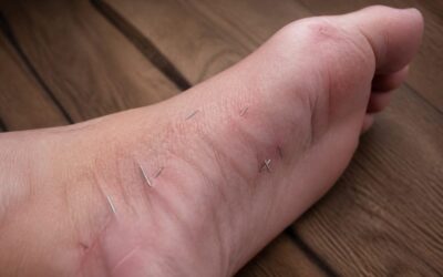 O femeie a ajuns la spital cu peste 10 fragmente de ace în picior după o ședință de acupunctură
