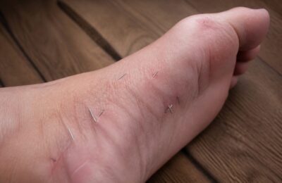 O femeie a ajuns la spital cu peste 10 fragmente de ace în picior după o ședință de acupunctură