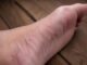 O femeie a ajuns la spital cu peste 10 fragmente de ace în picior după o ședință de acupunctură